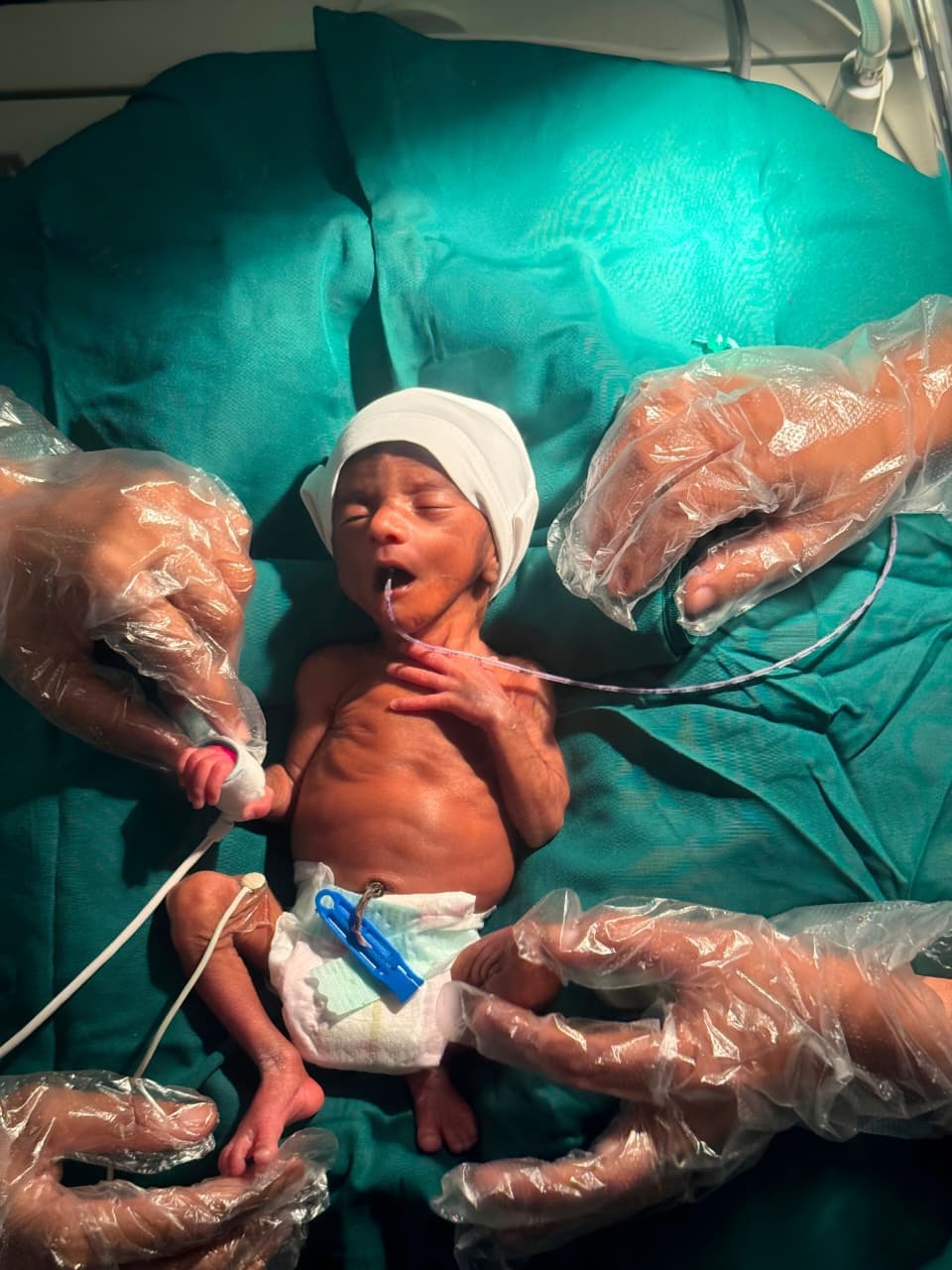 Premature Baby Care